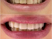Teeth Reshaping
